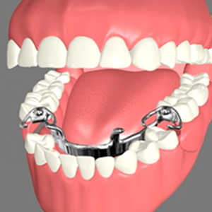 Partial Dentures Partial Dentures